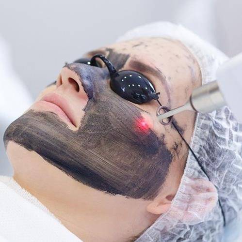 Carbon facial treatment