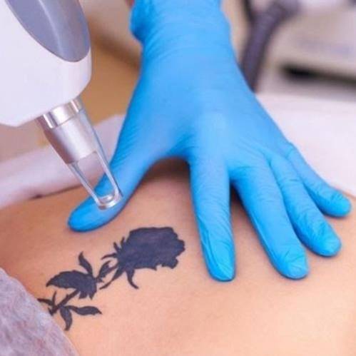 Tattoo removal treatment