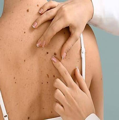 Skin Tags Treatment